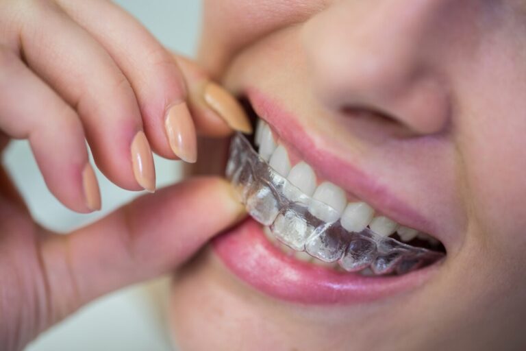 Nakładki ortodontyczne Invisalign dla nastolatków