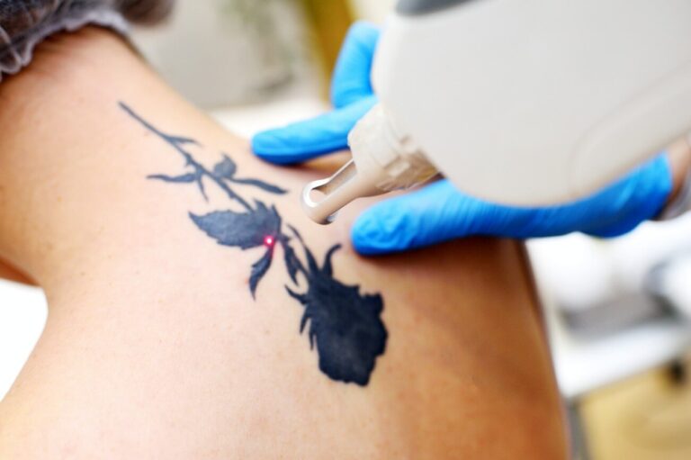 Tatuaż nie musi Ci towarzyszyć przez całe życie – poznaj zalety laserowego usuwania tatuażu